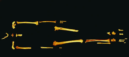 The Tianyuan skeleton